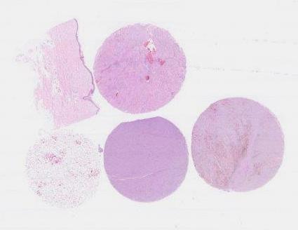 MSA/HMB-45 Last Run 2014 1. Skin, 2. Kidney, 3. Angiomyolipoma, 4. Malignant melanoma 5.