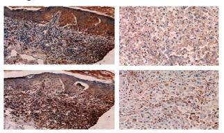 Melanoma In Situ with Extensive Regression: primary and metastasis CDH3 Radial growth