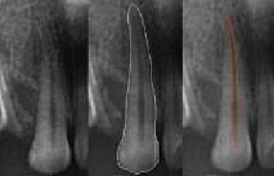 Gingival recession Root surface resorption Discolouration and staining of teeth Changes in the chemical composition of teeth MATERIALS AND METHODS In this diagnostic study, 120 digital panoramic