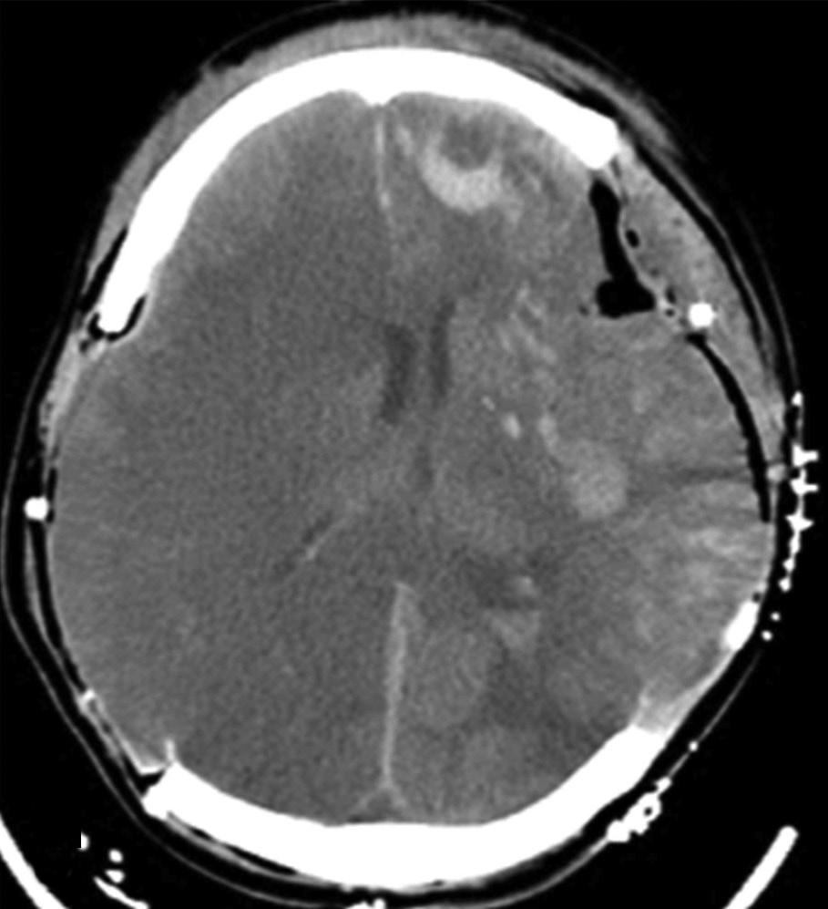The location of hematoma and skull fracture (if any), the Rotterdam CT score including the compression of basal cisterns, midline shift, epidural mass lesion, intraventricular blood, and/or traumatic