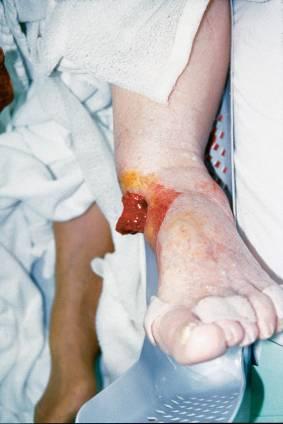 Extremity Trauma Extremity injuries Fractures Dislocations Amputations Open wounds