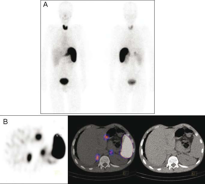 Figure 6. (A) Planar SAP scan image (anterior / posterior) of a patient with AA amyloidosis. The adrenal glands are difficult to assess. (B) SPECT/CT images show uptake in both adrenal glands 15.