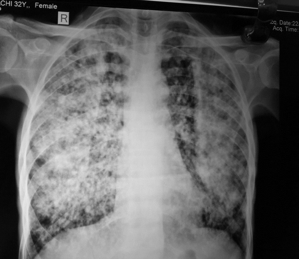 Case 1 PM 32 F Miliary TB :