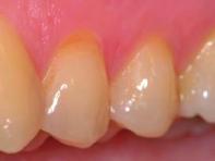 3. Less than category 4, but more than 50% of the difference between categories 1 and 4. Significant sclerosis present. Dentin is dark yellow or 4. even discolored (brownish).