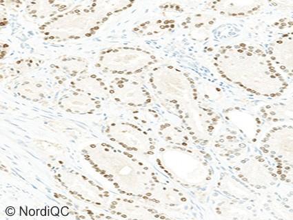 Fig. 4a Optimal NKX3.1 staining of the prostate adenocarcinoma no. 4, using same protocol as in Figs. 1a - 3a.