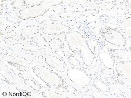 1 of the prostate adenocarcinoma no. 4, using same protocol as in Figs. 1b 3b. same field as in Fig. 4a.