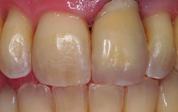 This measure is an important region in order to transport light into the gingival with the ceramic