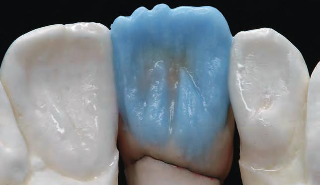 transparent cladding towards the approximal space and the incisal region