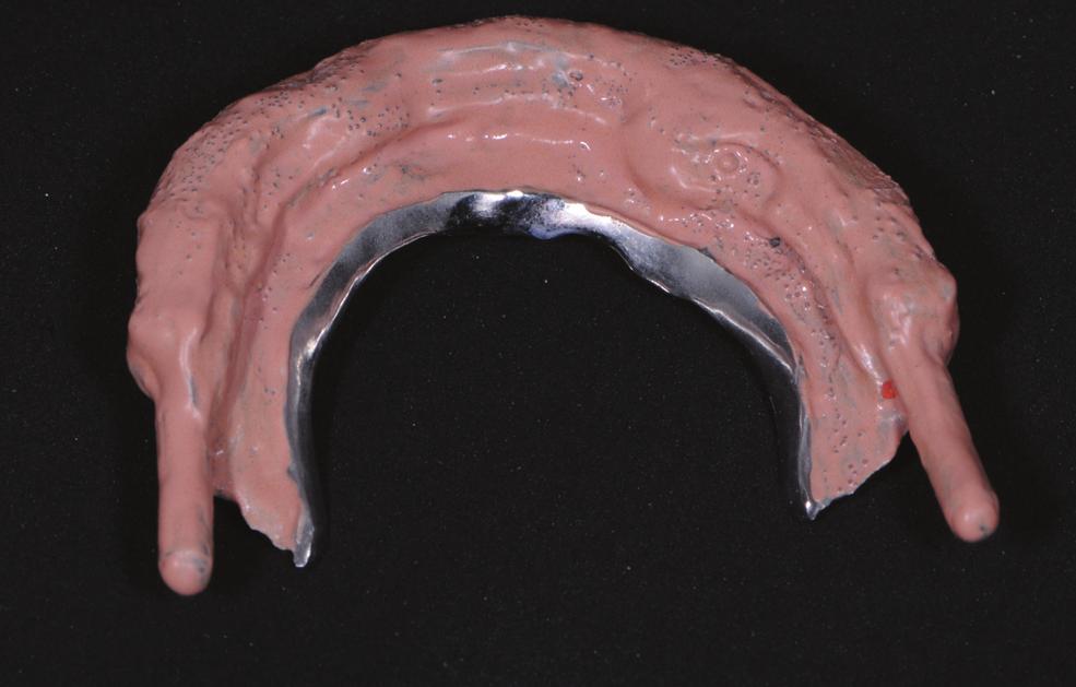 Conclusion In the attempts to restore oral implants in the edentulous mandible, Dolder bars appear to offer a high rate of implant survival, good stability of the peri-implant tissue, and a low rate