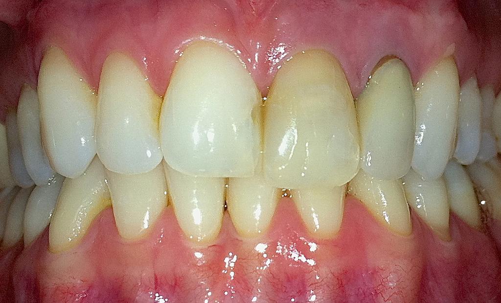 T he patient, aged 30, was not happy with the unaesthetic appearance of the maxillary incisor group, in what concerned teeth 2.1 and 2.2. The 2.