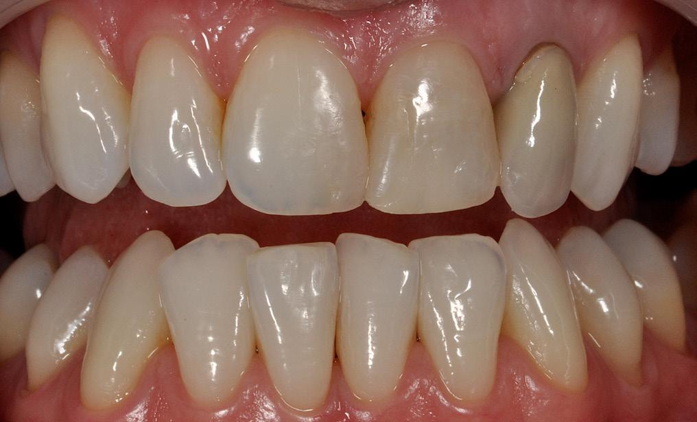 and marginal adaptation. Chronic gingivitis, a 2mm buccal gingival retraction and a modified zenith were discovered periodontally to 2.2. At the level of the 2.