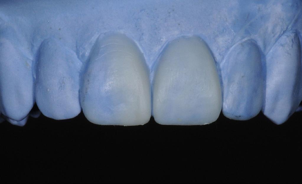 Although tooth 1.1 was not initially included in the prosthetic plan, it was restored by means of a large composite filling, with mesial angle restoration.