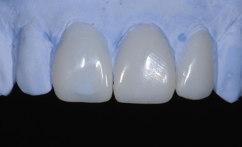 Their adhesive reconstruction was carried out by intraradicular retention of the composite mass with glass fibre pins. Subsequently, during the odontal retreatment of 1.