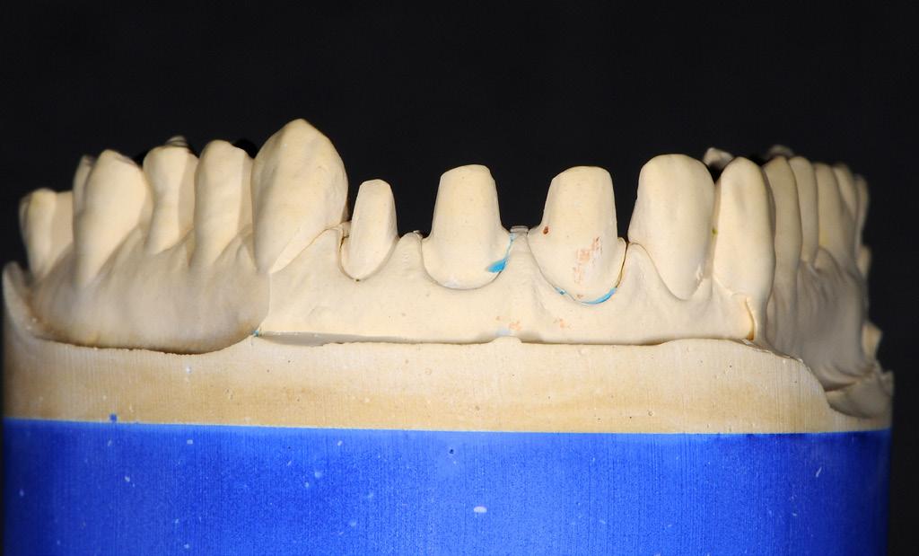 Teeth 2.1 and 2.2 were prepared with threshold scaling, a classic for crowns, and 1.