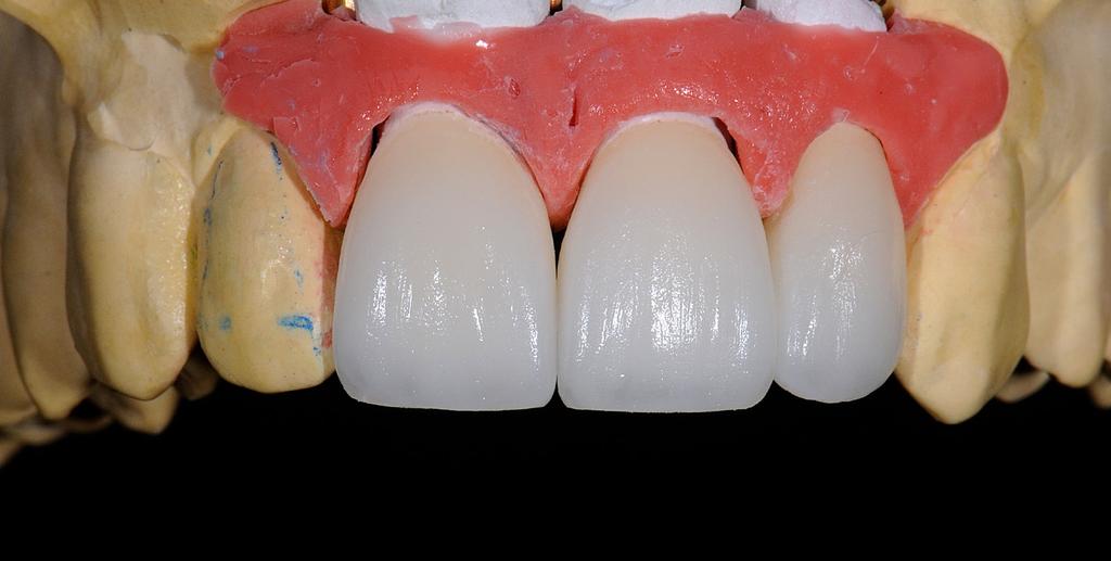 The next firing was carried out with dentin masses, and for tooth 11, incisally, with opals.