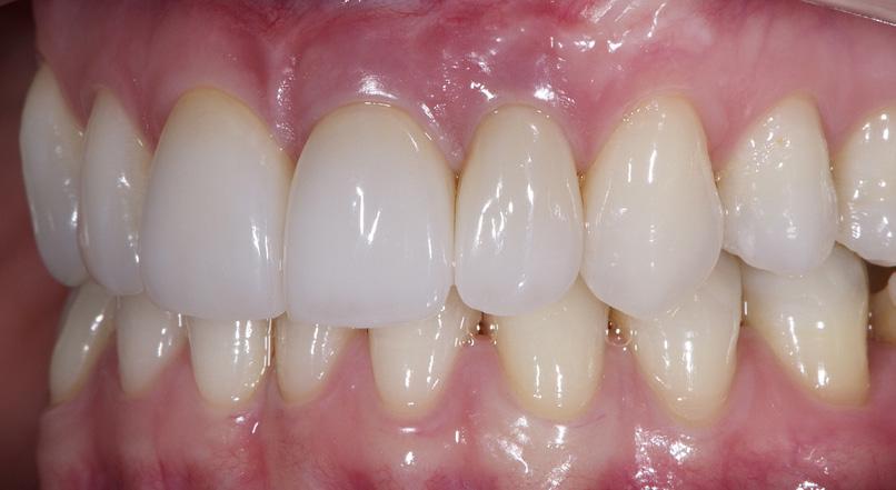 AT THE RESTORATIVE LEVEL 1. The crowns were prepared by being placed in a silicone matrix that made them easier to handle. 2. They were carved in 9.
