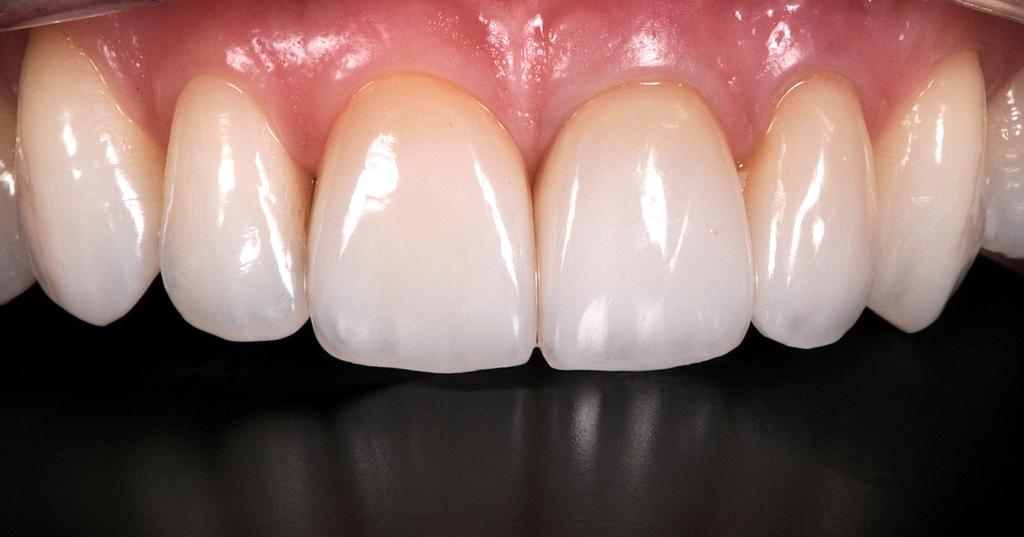 The inner surfaces were styled with a fifth generation adhesive, compatible with the dual grip cements. They were then protected from light. AT THE LEVEL OF DENTAL PREPARATIONS 1.
