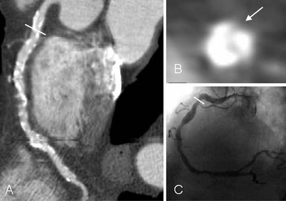 Figure 1. Example of evaluation of stenoses in highly calcified right coronary artery (RCA). (A) Curved multiplanar reconstruction of the RCA is shown, demonstrating multiple obstructive stenoses.