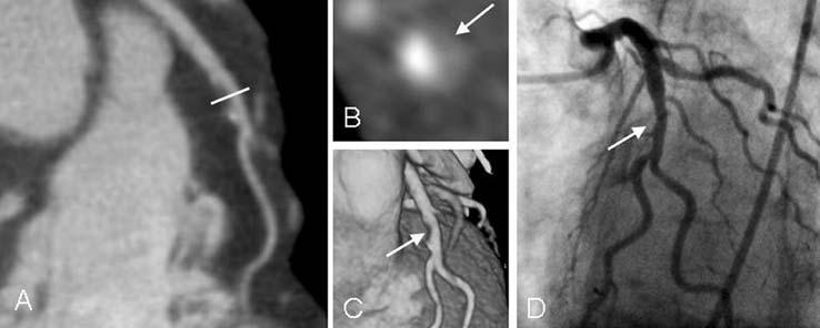 view of the RCA are depicted in (A) and (C)). Invasive coronary angiography confirmed multiple obstructive stenoses in the RCA (C). Figure 2.