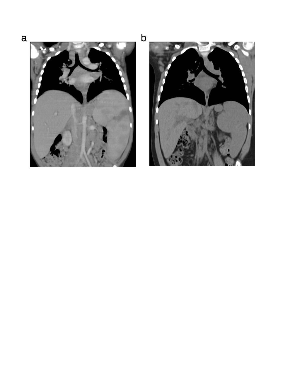 Supplementary Figure 9. CT images comparing hepatosplenomegaly and lymphadenopathy in patient A.1 before and after treatment with rapamycin.