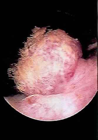 tumor 2 years ago Upper tracts normal on