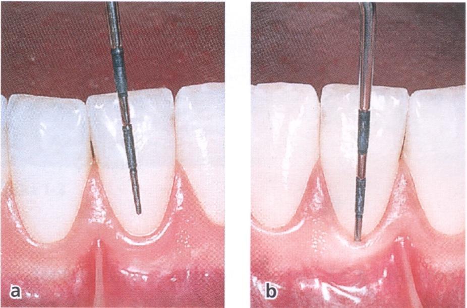 To je pribliţno i dubina gingivalnog sulkusa jer se smatra da se gingivalna brazda nalazi u nivou dna gingivalnog sulkusa Slika 2. Slobodna i pripojna gingiva 9.