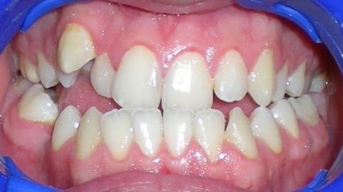 Ovaj sistem se pokazao izuzetno efikasnim i delotvornim zbog konstantnosti delovanja sila na zube koje su dovoljno jake da ostvare ţeljeni