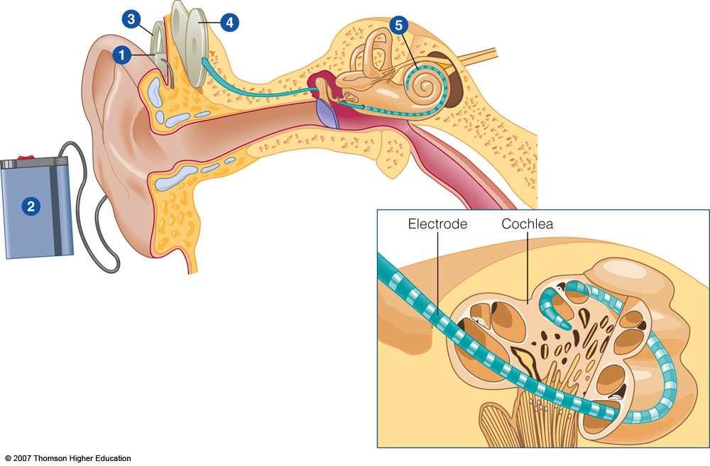 Cochlear Implants Implants stimulate the cochlea at different places on the tonotopic map according to specific frequencies in the stimulus These devices help deaf people to hear some sounds