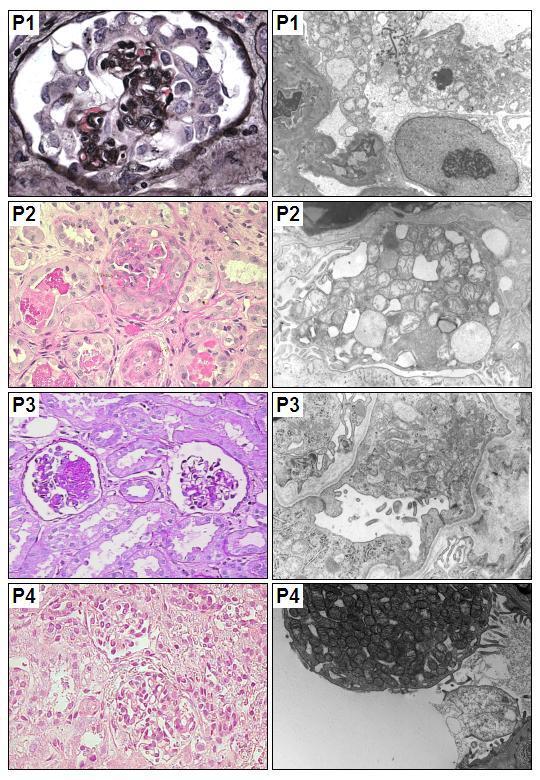 Renal disease in COQ2 mutations Age onset (months) Extra-renal symptoms Renal symptoms Renal pathology Diomedi-Camassei et al, JASN 2007 18 None SRNS