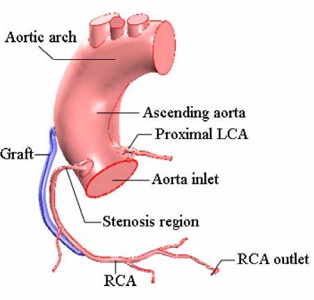 NUMERICAL STUDY OF PULSATILE BLOOD 89 stenosis region, and the graft connected between ascending aorta and the RCA, as shown in Figure 2. The stenosis area is at 1.