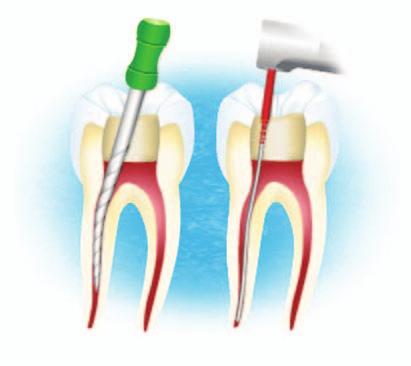 D. Shori, BDS, MDS Abstract Aim: The aim of this study was to compare sizes of the first instrument with or without a taper that binds at the apical constriction of a root canal after coronal flaring.