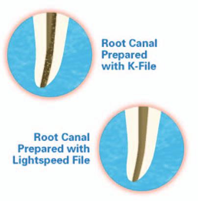 flaring because determination of the initial narrow apical canal diameter plays a major factor in identifying the extent of final apical shaping.