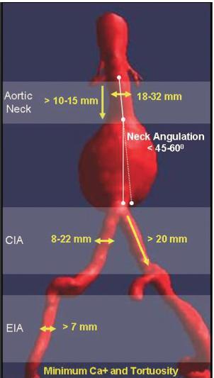 Suitable AAA Morphology for EVAR Aortic neck - Diameter: 18~32 mm - Length: >10~15 mm - Shape: straight, non-conical - Angulation