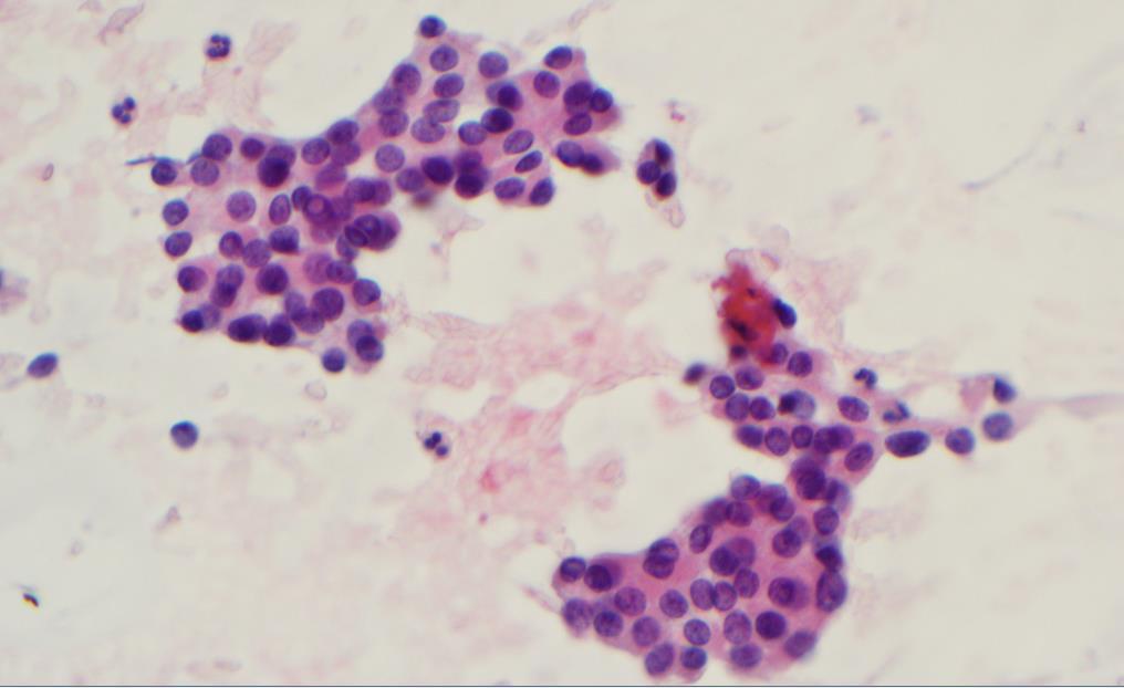 10-25% of FNA will lead to indeterminate thyroid nodules ATYPIA OF UNDETERMINED