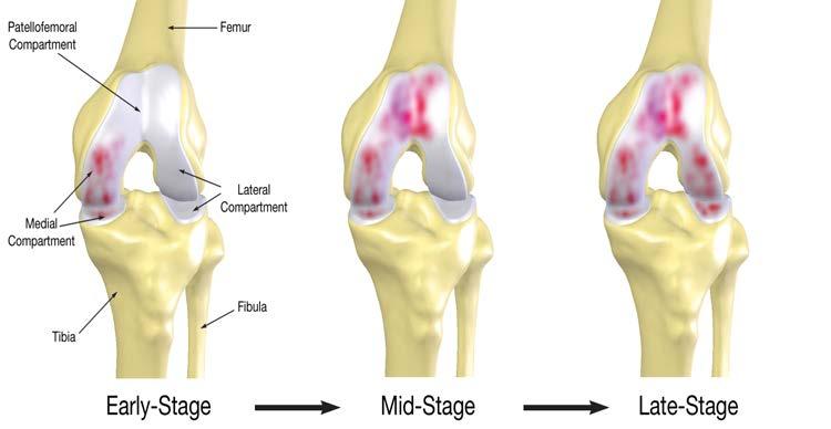 Osteoarthritis Knee http://www.regionalorthopedic.