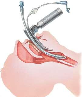 6. Intubation 1.