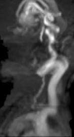 Echo showed retrograde flow in the aorta during diastole.