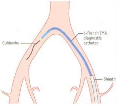 femoral artery