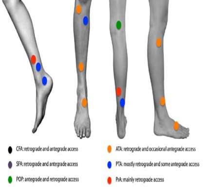 Access to the lesion Tibial vessels IMAGING before selection!
