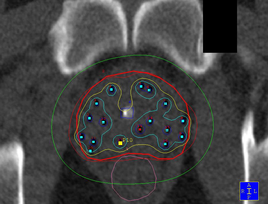 Example Case # 1 Treatment Delivery Verification: Off-Line Procedure CT based 1 x Implant + 4 x