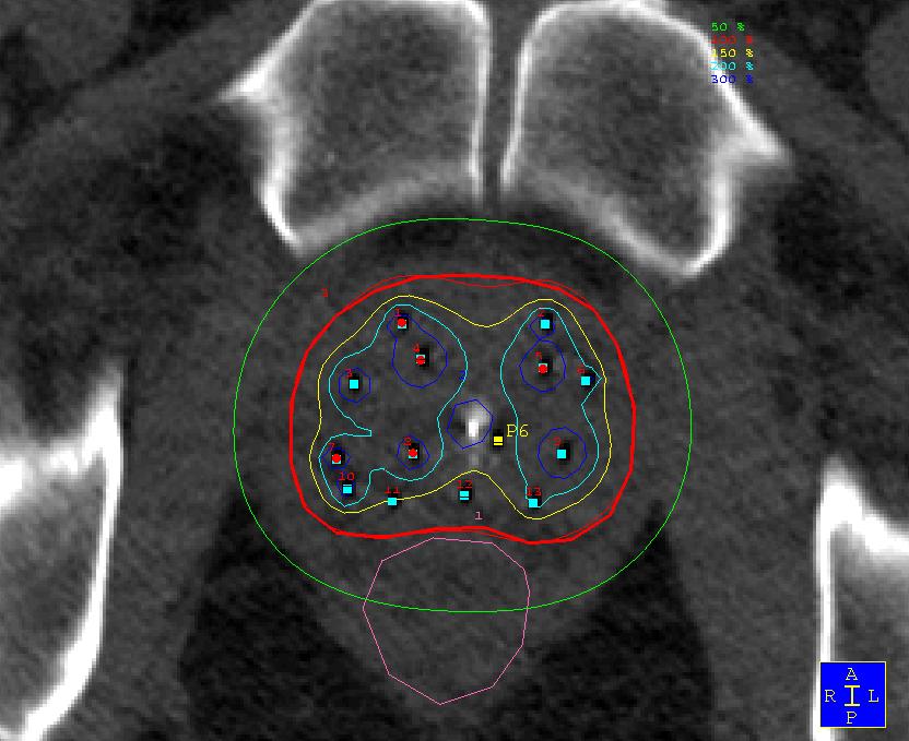 Example Case # 2 Treatment Delivery Verification: Off-Line Procedure CT based 1 x Implant + 4 x Fractions