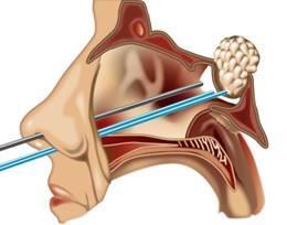 Transsphenoidal Surgery The pituitary is accessed