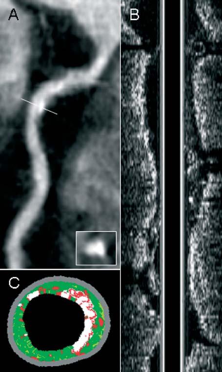 QCA and gray-scale IVUS. A good intra- and inter-observer agreement was observed for the evaluation of stenosis severity on QCA (mean difference 7.4±7.2% and 8.1±7.4%, respectively).