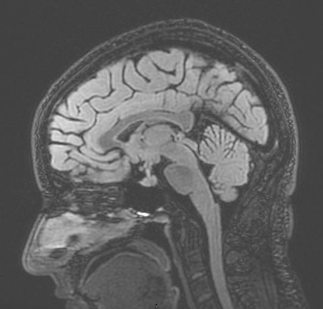 MRI 8ch head