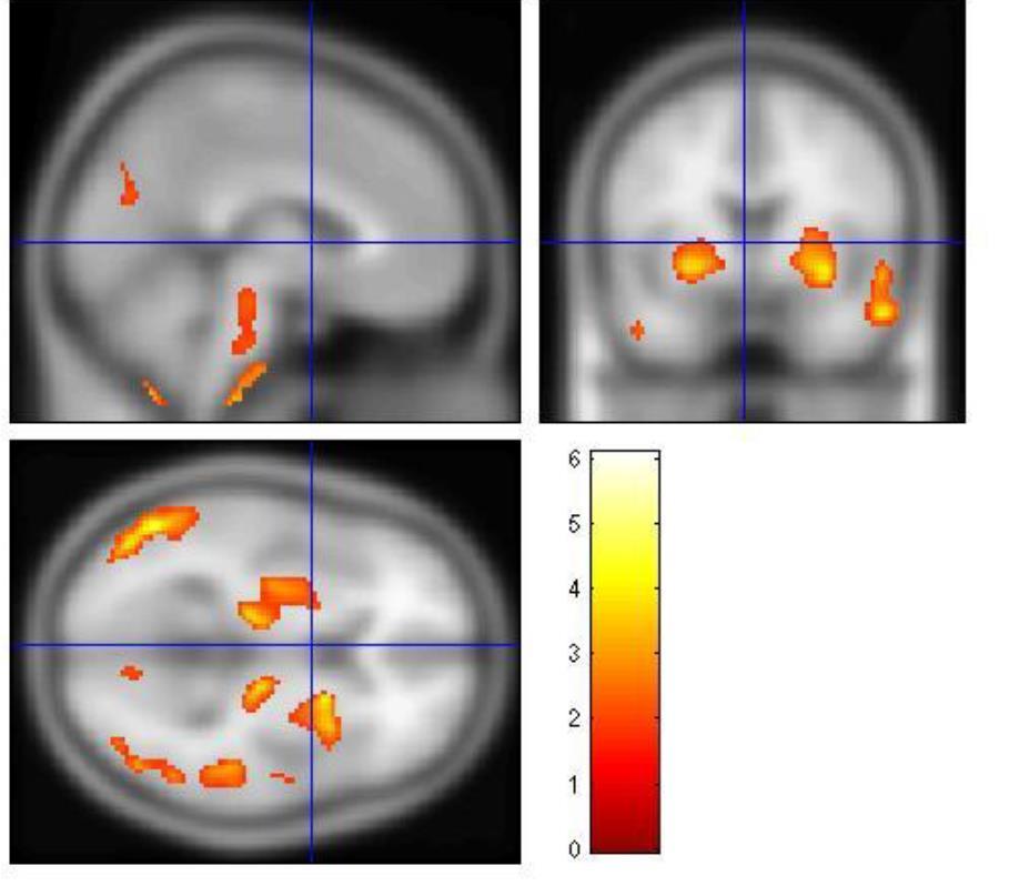 MRI abnormalities Increased microglial reactivity