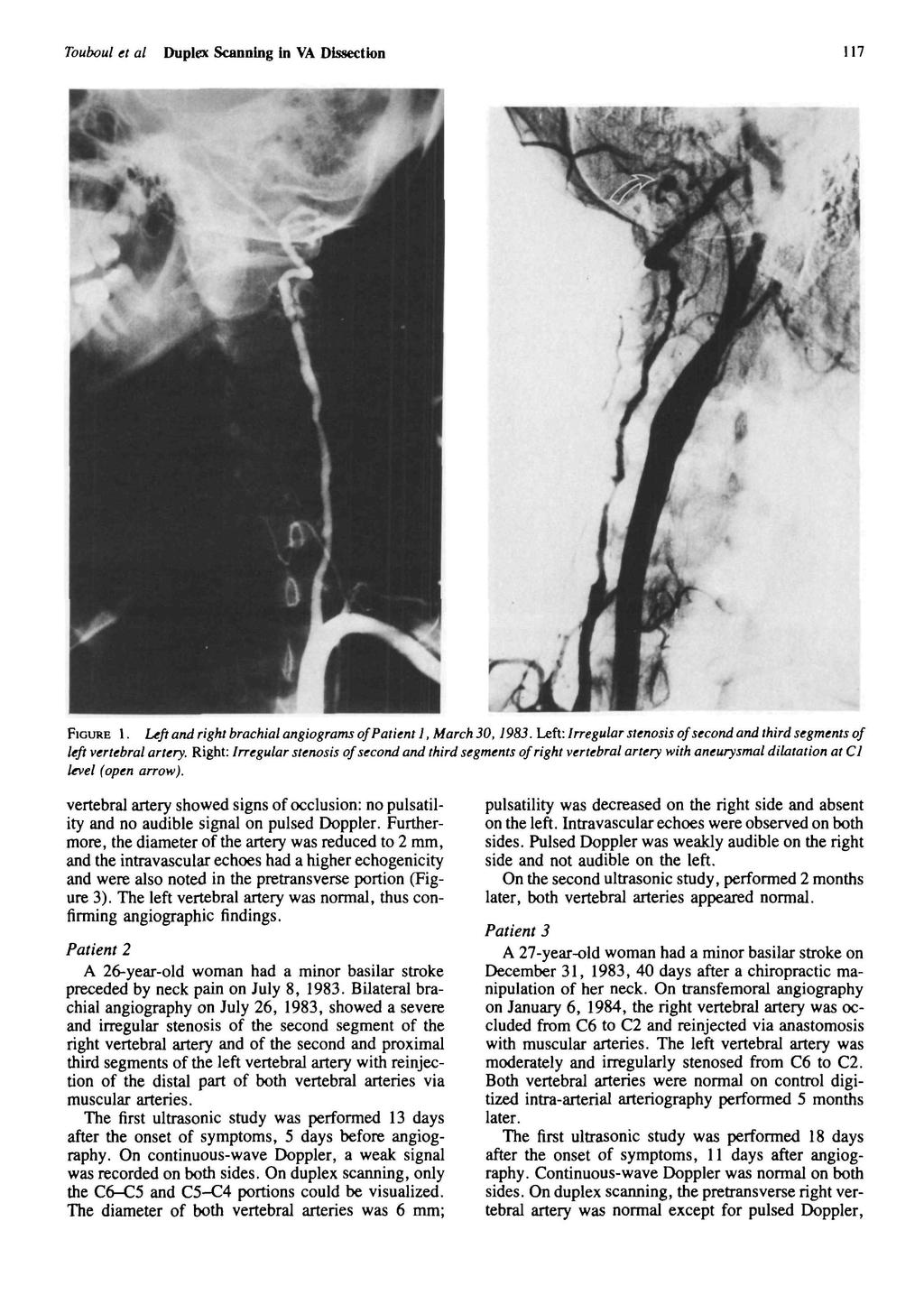 Touboul et al Duplex Scannng n VA Dssecton 117 FIGURE 1. Left and rght brachal angograms ofpatent 1, March,198. Left: Irregular stenoss of second and thrd segments of left vertebral artery.