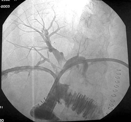 78 Figure 3. Post-operative cholangiogram showed success of the modified porto-enterostomy. lesson that hepatobiliary and general surgeons should adopt for surgical treatment of biliary surgery.