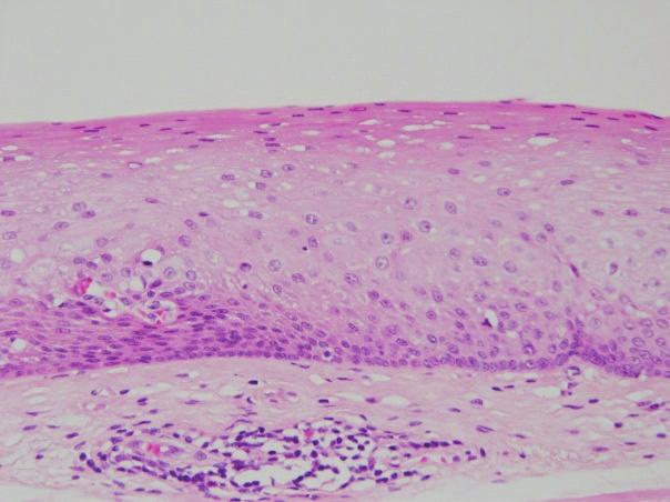 This lesion ws grded s non-neoplstic lesion.