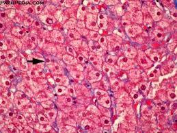 LIVER, FIBROGENESIS The space of Disse contains large amounts of type I