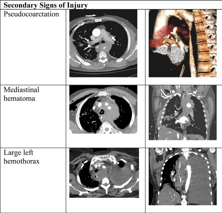 Parameters for successful non-operative management of traumatic aortic injury Joseph Rabin, MD, Joe DuBose, MD, Clint W. Sliker, MD, James V. O Connor, MD, Thomas M. Scalea, MD, and Bartley P.